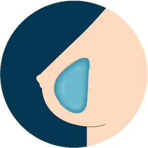 Select Breast Option